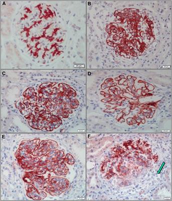 Renal C4d is a potential biomarker of disease activity and severity in pediatric lupus nephritis patients